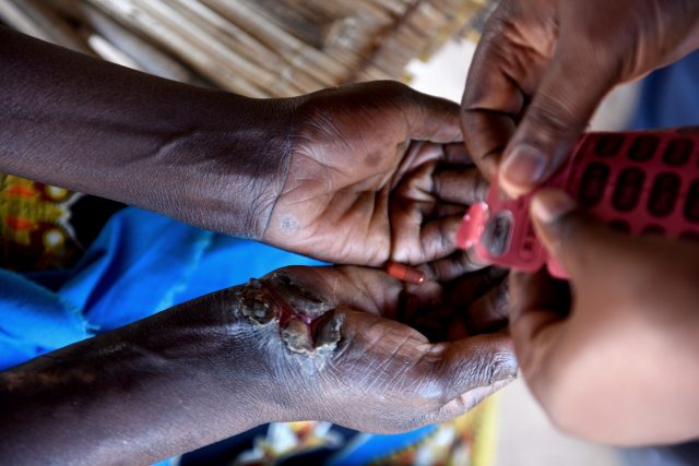 Person affected by leprosy receives leprosy treatment pills