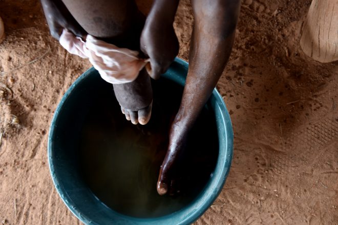 Patient affected by lymphatic filariasis doing self-care